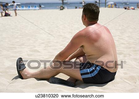 Sunburn View Large Photo Image Stock Image - Sunburn. Fotosearch