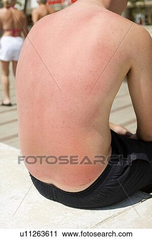 Sunburnt skin View Large Photo Image Stock Image - Sunburnt skin. Fotosearch