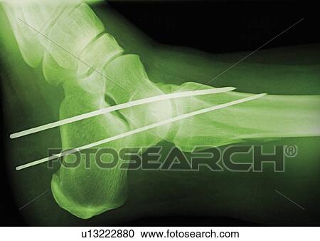 Temporary ankle immobilisation, X-ray View Large Photo Image Stock Image - Temporary ankle immobilisation, X-ray. Fotosearch