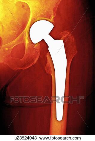 Total hip replacement, X-ray View Large Photo Image Stock Image - Total hip replacement, X-ray. Fotosearch