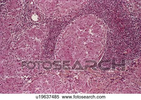 Stock Photography - Tuberculosis, light micrograph. Fotosearch