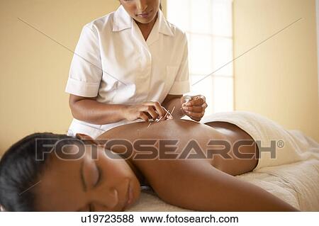 Stock Photo - Acupuncture. Fotosearch