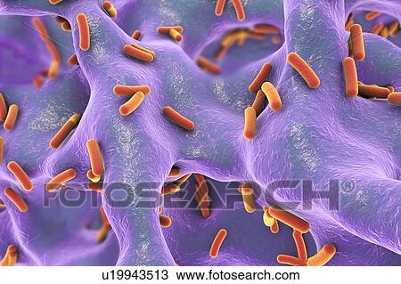 Stock Image - Bacterial infection of bone, illustration. Fotosearch