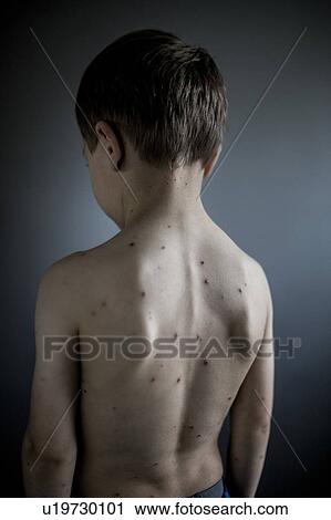 Boy with chicken pox View Large Photo Image Stock Image - Boy with chicken pox. Fotosearch