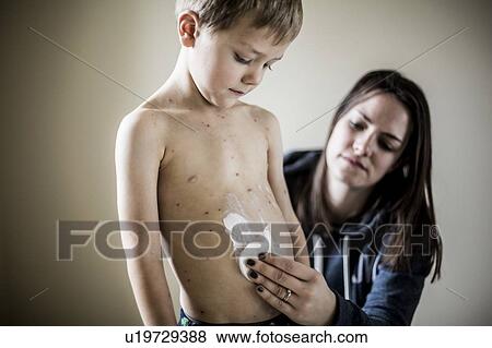 Boy with chicken pox View Large Photo Image Stock Photo - Boy with chicken pox. Fotosearch