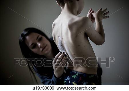 Stock Photo - Boy with chicken pox. Fotosearch