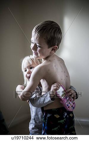 Picture - Boy with chickenpox. Fotosearch