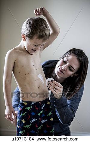 Picture - Boy with chickenpox. Fotosearch
