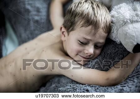 Stock Image - Boy with chickenpox. Fotosearch