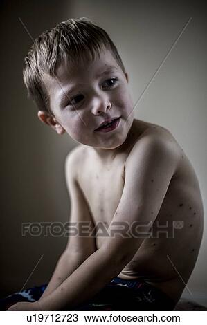 Boy with chickenpox View Large Photo Image Stock Image - Boy with chickenpox. Fotosearch