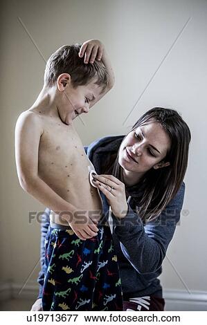 Stock Photo - Boy with chickenpox. Fotosearch