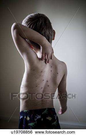 Boy with chickenpox View Large Photo Image Stock Photograph - Boy with chickenpox. Fotosearch