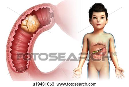 Cancer, small intestine, illustration View Large Photo Image Stock Image - Cancer, small intestine, illustration. Fotosearch