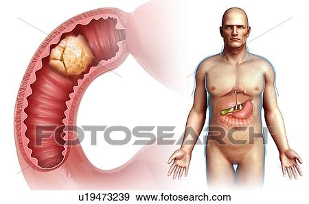 Stock Photo - Cancer, small intestine, illustration. Fotosearch
