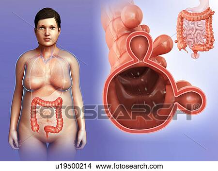 Picture - Diverticulosis, illustration. Fotosearch