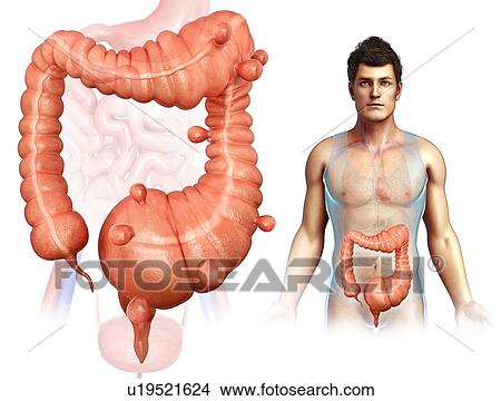 Picture - Diverticulosis, illustration. Fotosearch