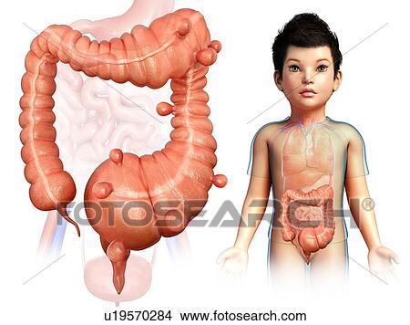 Picture - Diverticulosis, illustration. Fotosearch