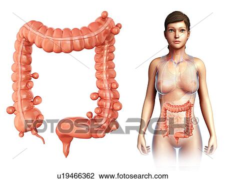 Stock Image - Diverticulosis, illustration. Fotosearch