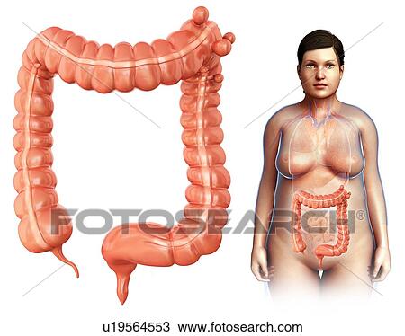 Stock Image - Diverticulosis, illustration. Fotosearch
