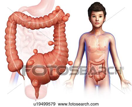 Stock Photo - Diverticulosis, illustration. Fotosearch