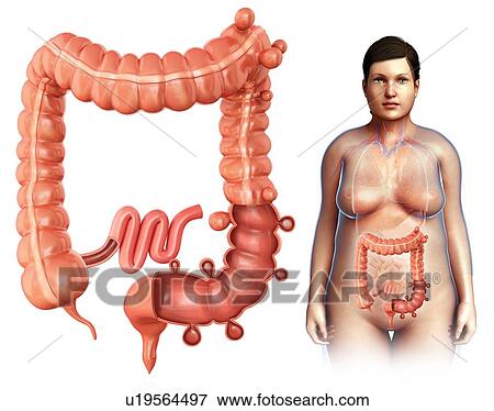 Stock Photo - Diverticulosis, illustration. Fotosearch