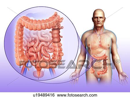 Stock Photograph - Diverticulosis, illustration. Fotosearch