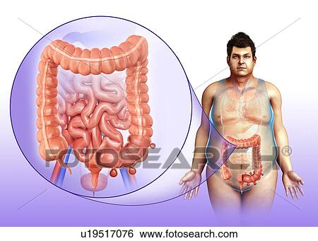 Stock Photograph - Diverticulosis, illustration. Fotosearch
