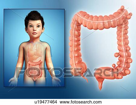 Diverticulosis in a child, illustration View Large Photo Image Picture - Diverticulosis in a child, illustration. Fotosearch