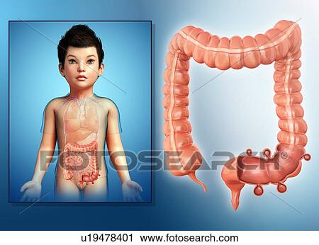 Diverticulosis in a child, illustration View Large Photo Image Stock Image - Diverticulosis in a child, illustration. Fotosearch