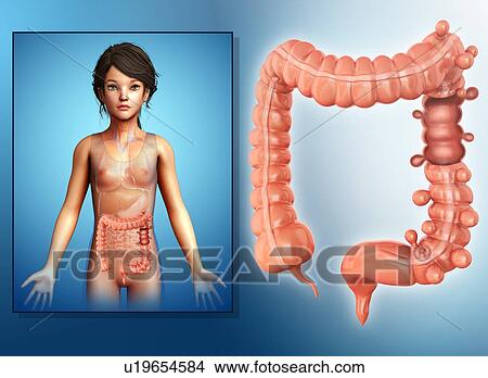 Picture - Diverticulosis of colon, illustration. Fotosearch