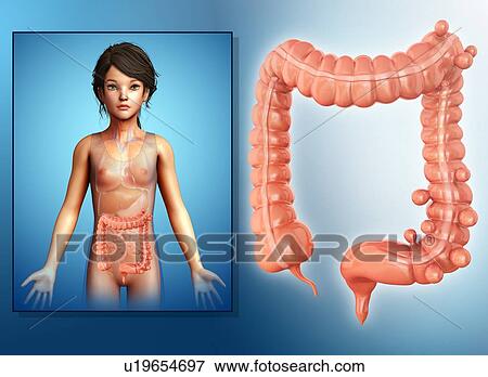 Stock Photo - Diverticulosis of colon, illustration. Fotosearch
