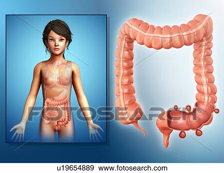 Stock Photo - Diverticulosis of colon, illustration. Fotosearch