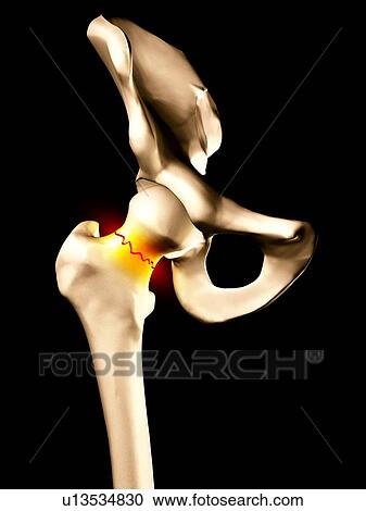 Stock Image - Fractured hip bone, artwork. Fotosearch