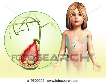 Gallstones in the bladder, illustration View Large Photo Image Stock Photography - Gallstones in the bladder, illustration. Fotosearch