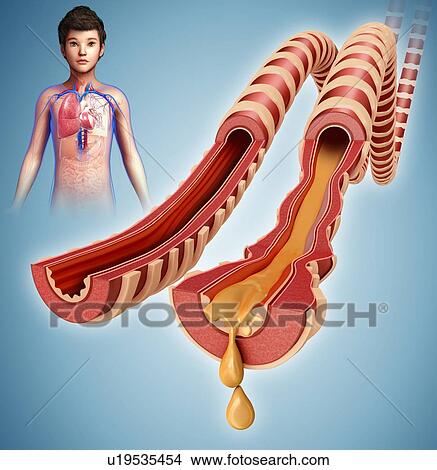Infected bronchi of a child, illustration View Large Photo Image Picture - Infected bronchi of a child, illustration. Fotosearch