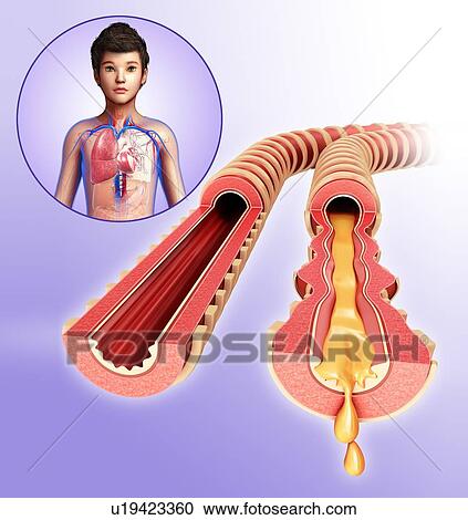 Infected bronchi of a child, illustration View Large Photo Image Stock Image - Infected bronchi of a child, illustration. Fotosearch