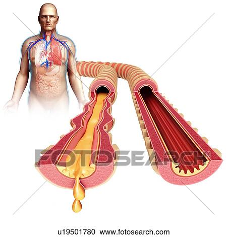 Stock Image - Infected bronchi of a child, illustration. Fotosearch