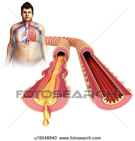 Infected bronchi of a child, illustration View Large Photo Image Stock Image - Infected bronchi of a child, illustration. Fotosearch