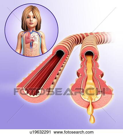 Stock Image - Infected bronchi of a child, illustration. Fotosearch