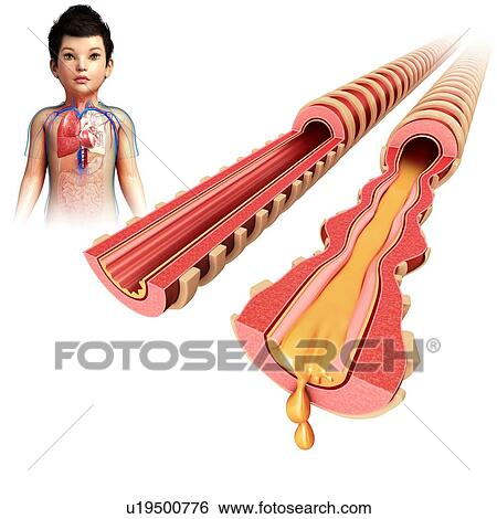 Stock Photograph - Infected bronchi of a child, illustration. Fotosearch