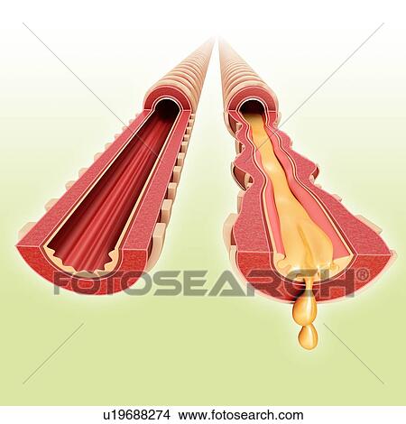 Picture - Infected bronchus, illustration. Fotosearch
