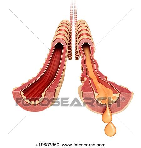 Stock Image - Infected bronchus, illustration. Fotosearch