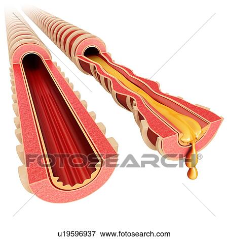 Stock Photo - Infected bronchus, illustration. Fotosearch
