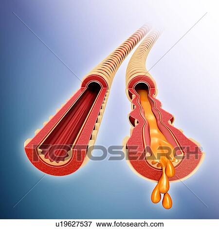 Stock Photo - Infected bronchus, illustration. Fotosearch