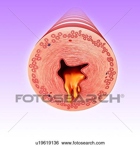 Stock Photograph - Infected bronchus, illustration. Fotosearch