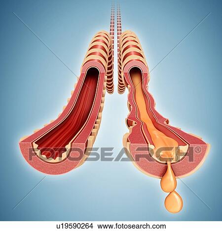 Infected human bronchus, illustration View Large Photo Image Picture - Infected human bronchus, illustration. Fotosearch