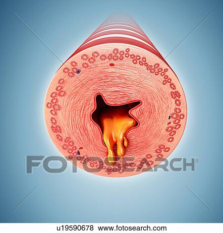 Infected human bronchus, illustration View Large Photo Image Stock Photo - Infected human bronchus, illustration. Fotosearch