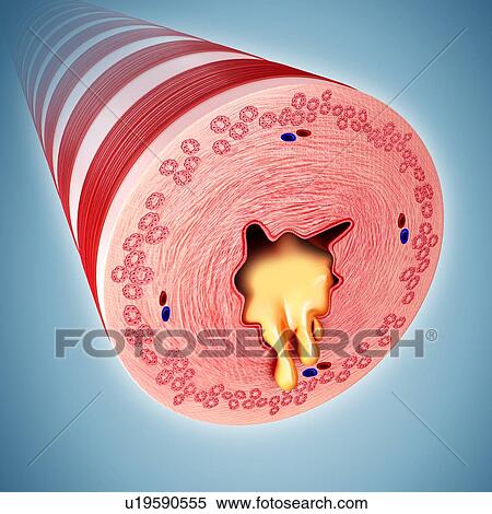 Infected human bronchus, illustration View Large Photo Image Stock Photography - Infected human bronchus, illustration. Fotosearch
