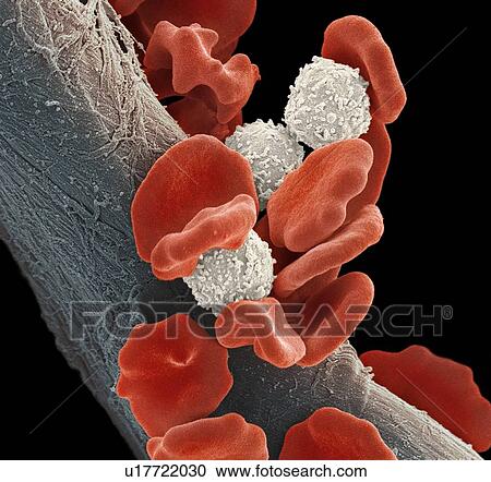 Stock Image - Leukaemia blood cells, SEM. Fotosearch