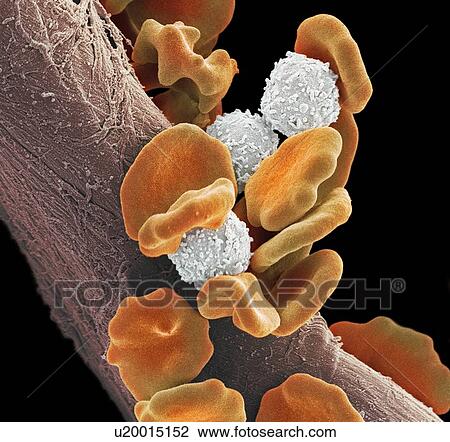 Leukaemia blood cells, SEM View Large Photo Image Stock Image - Leukaemia blood cells, SEM. Fotosearch